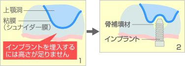 サイナスリフト