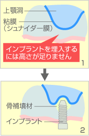 サイナスリフト