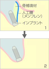 GBR（骨誘導再生治療）